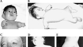 Roberts syndrome