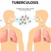 Tuberculosis