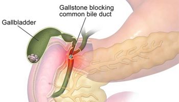 cholelithiasis