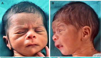 fetal hydantoin syndrome facial and limb abnormalities