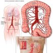mesenteric vascular insufficiency