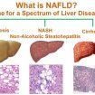 nonalcoholic steatohepatitis