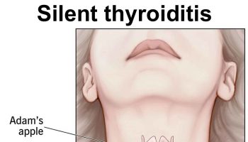 silent thyroiditis