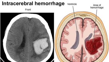 Intracerebral hemorrhage