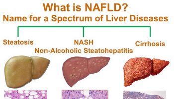 non alcoholic fatty liver disease