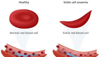 Sickle cell anemia