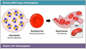 Sickle-cell-disease