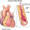 familial combined hyperlipidemia