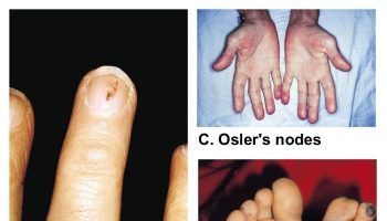 infective endocarditis