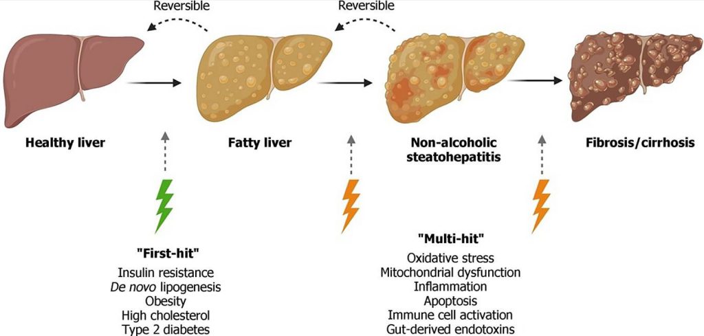 Nonalcoholic steatohepatitis, causes, symptoms, diagnosis, treatment ...