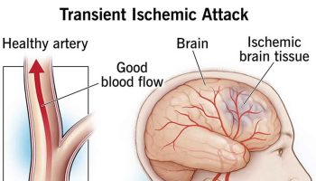 transient ischemic attack