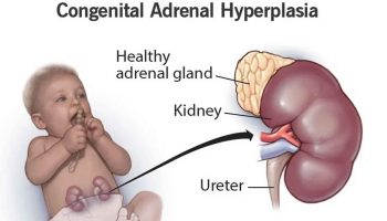 Congenital adrenal hyperplasia