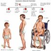 Duchenne muscular dystrophy