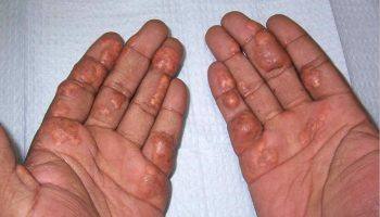 Palmar xanthoma in familial dysbetalipoproteinemia