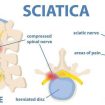 Sciatica