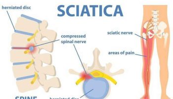 Sciatica