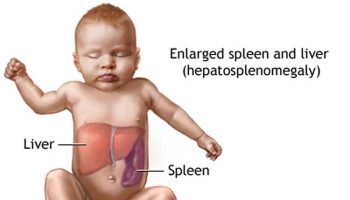 hepatosplenomegaly