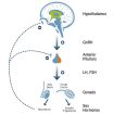 hypogonadism