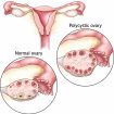 polycystic ovarian disease