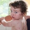 chicken pox