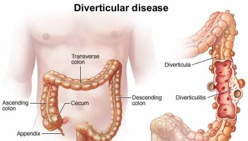 Diverticular disease