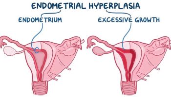 endometrial-hyperplasia