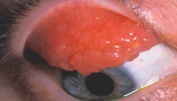 Allergic keratoconjunctivitis