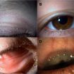 Atopic keratoconjunctivitis