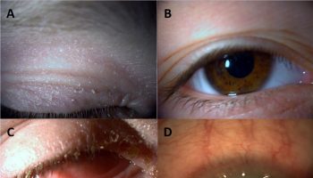 Atopic keratoconjunctivitis