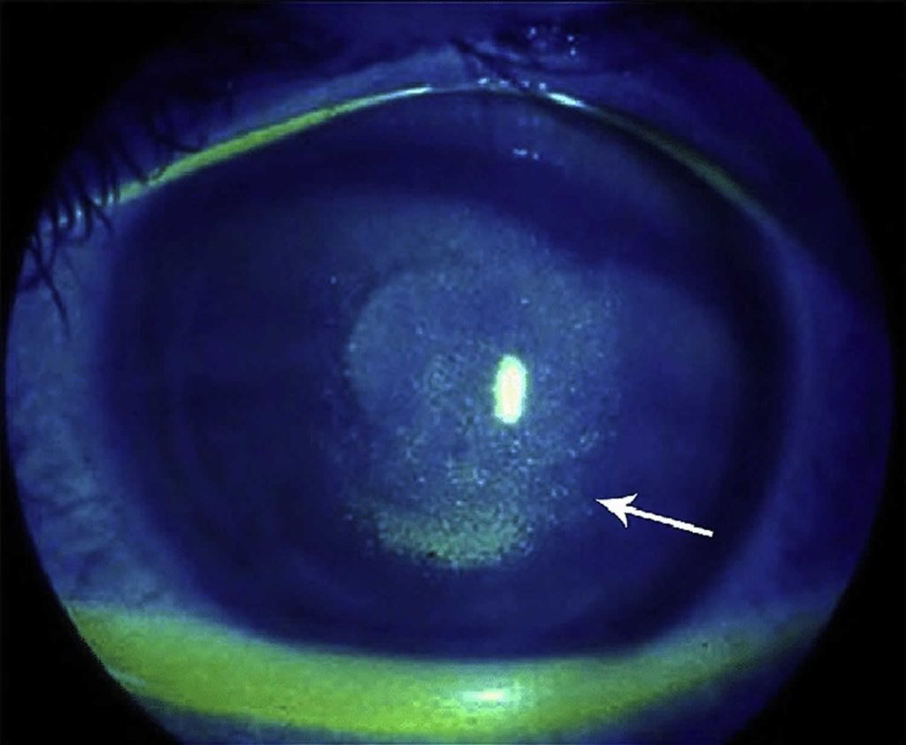 Keratoconjunctivitis sicca, causes, symptoms, diagnosis, treatment ...