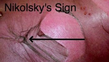 Nikolsky sign