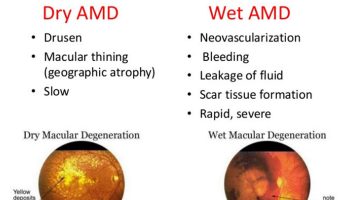 age related macular degeneration