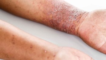 atopic-dermatitis