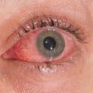 conjunctivitis