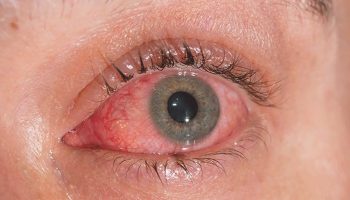 conjunctivitis