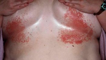 cutaneous-candidiasis