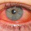 keratoconjunctivitis