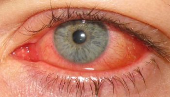 keratoconjunctivitis