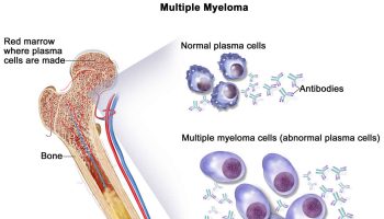 Multiple myeloma