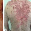 pemphigus vulgaris disease