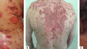 pemphigus vulgaris disease