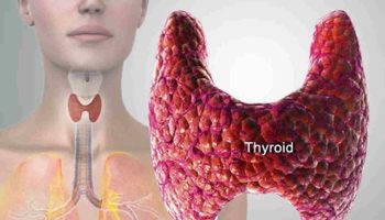 subacute thyroiditis