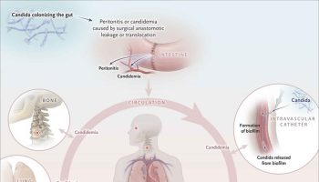 systemic-candidiasis