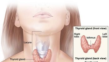 thyroid storm