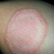 tinea-corporis
