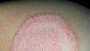 tinea-corporis