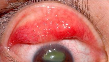 vernal conjunctivitis