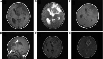 Ependymoma