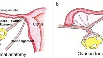 Ovarian-torsion