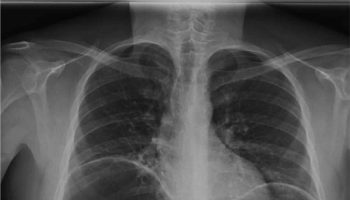 Pneumoperitoneum